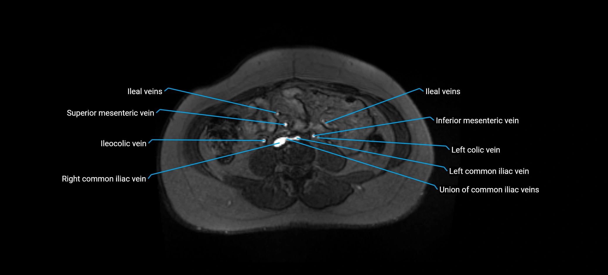 MRV abdomen pelvis & lower limb axial cross sectional anatomy labelled MRI image 109 (1).webp